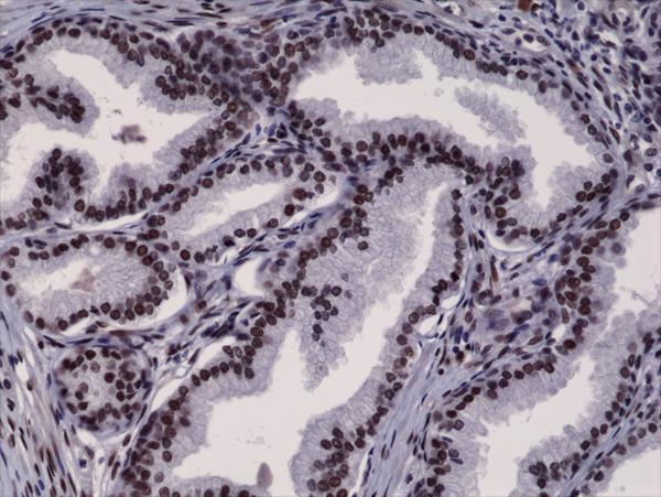  IHC resultImmunohistochemical staining of formalin fixed and paraffin embedded human prostate cancer tissue section using anti-Androgen Receptor (N-term) rabbit monoclonal antibody (Clone RM254) at a 1:2500 dilution