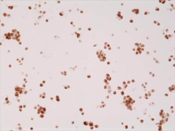  IHC resultImmunohistochemical staining of formalin fixed and paraffin embedded 22RV1 cells sections using anti-Androgen Receptor (N-term) rabbit monoclonal antibody (Clone RM254) at a 1:2500 dilution