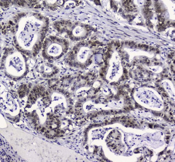 IHC analysis of APE1 using anti-APE1 antibody (M00627). APE1 was detected in paraffin-embedded section of human intestinal cancer tissue. Heat mediated antigen retrieval was performed in citrate buffer (pH6, epitope retrieval solution) for 20 mins. The tissue section was blocked with 10% goat serum. The tissue section was then incubated with 2μg/ml mouse anti-APE1 Antibody (M00627) overnight at 4°C. Biotinylated goat anti-mouse IgG was used as secondary antibody and incubated for 30 minutes at 37°C. The tissue section was developed using Strepavidin-Biotin-Complex (SABC)(Catalog # SA1021) with DAB as the chromogen. "