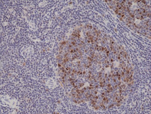  IHC resultImmunohistochemical staining of formalin fixed and paraffin embedded human tonsil tissue sections using Anti-Aurora B Rabbit Monoclonal Antibody (Clone RM278) at a 1:500 dilution