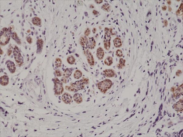  IHC resultImmunohistochemical staining of formalin fixed and paraffin embedded human breast cancer tissue section using anti-S100B rabbit monoclonal antibody (Clone RM304) at a 1:1000 dilution