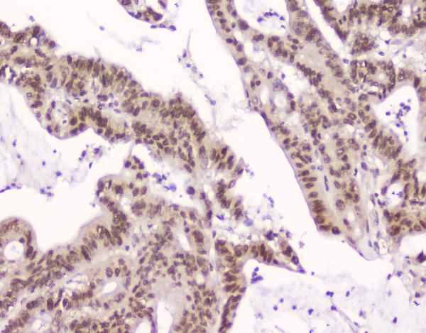 IHC analysis of CRM1 using anti-CRM1 antibody (M01180). CRM1 was detected in paraffin-embedded section of human intestinal cancer tissue. Heat mediated antigen retrieval was performed in citrate buffer (pH6, epitope retrieval solution) for 20 mins. The tissue section was blocked with 10% goat serum. The tissue section was then incubated with 2μg/ml mouse anti-CRM1 Antibody (M01180) overnight at 4°C. Biotinylated goat anti-mouse IgG was used as secondary antibody and incubated for 30 minutes at 37°C. The tissue section was developed using Strepavidin-Biotin-Complex (SABC)(Catalog # SA1021) with DAB as the chromogen.
