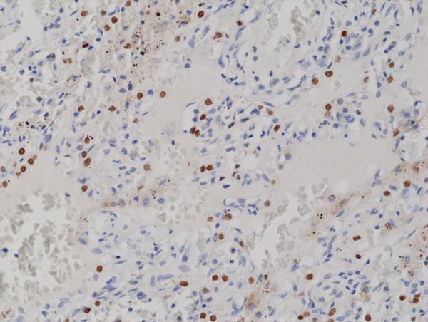  IHC resultImmunohistochemical staining of formalin fixed and paraffin embedded human lung cancer tissue section using anti-TTF1 rabbit monoclonal antibody (Clone RM373) at a 1:1000 dilution