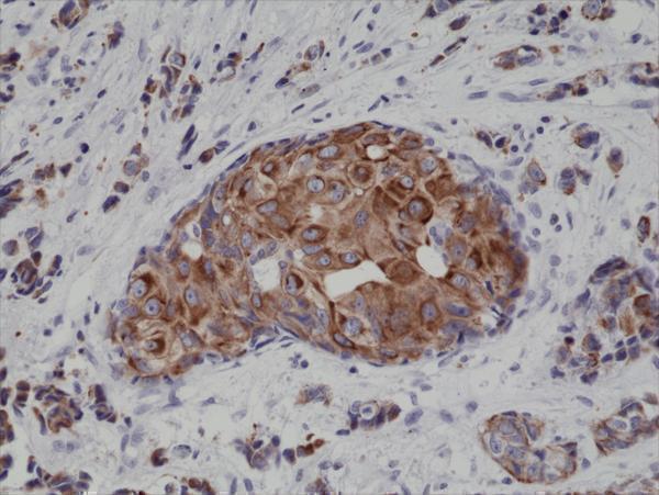  IHC resultImmunohistochemical staining of formalin fixed and paraffin embedded human breast cancer tissue sections using Anti-CK18 Rabbit Monoclonal Antibody (Clone RM279) at a 1:4000 dilution