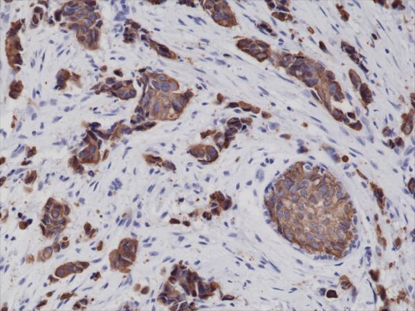  IHC resultImmunohistochemical staining of formalin fixed and paraffin embedded human breast cancer tissue sections using Anti-CK-8 Rabbit Monoclonal Antibody (Clone RM266) at a 1:2000 dilution