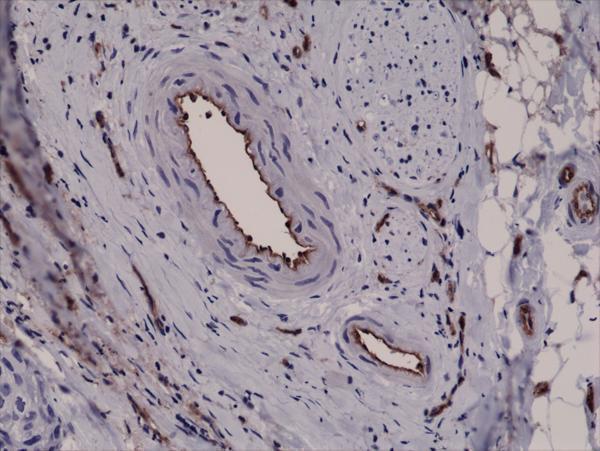  IHC resultImmunohistochemical staining of formalin fixed and paraffin embedded human breast cancer tissue sections using Anti-CD31 RM247 at a 1:2500 dilution