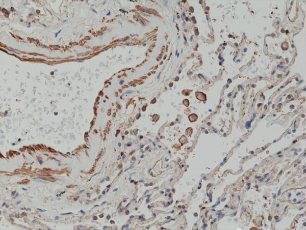  IHC resultImmunohistochemical staining of formalin fixed and paraffin embedded human lung cancer tissue section using anti-MMP-12 rabbit monoclonal antibody (Clone RM381) at a 1:2500 dilution