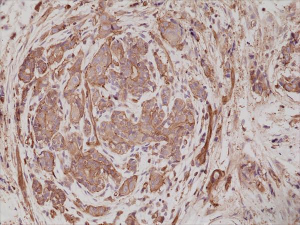  IHC resultImmunohistochemical staining of formalin fixed and paraffin embedded human breast cancer tissue sections using anti-alpha-Actinin-4 rabbit monoclonal antibody (clone RM287) at a 1:200 dilution