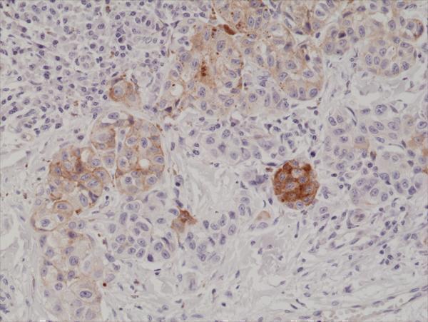  IHC resultImmunohistochemical staining of formalin fixed and paraffin embedded human melanoma tissue section using anti-MART1 rabbit monoclonal antibody (Clone RM333) at a 1:1000 dilution