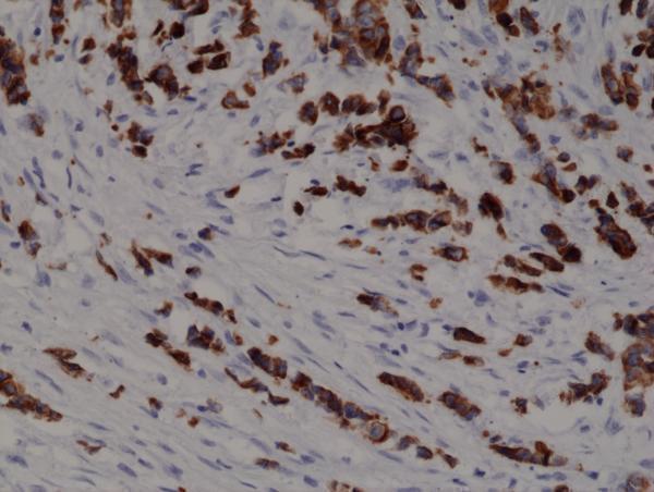  IHC resultImmunohistochemical staining of formalin fixed and paraffin embedded human breast cancer tissue section using anti-CK-19 rabbit monoclonal antibody (Clone RM364) at a 1:1000 dilution