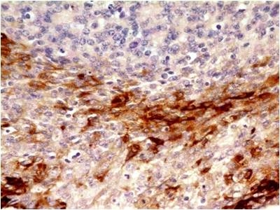 Immunohistochemical analysis of CD73 in endomatrium carcinoma using CD73 antibody (Clone: ABM40E2) at 5 µg/ml