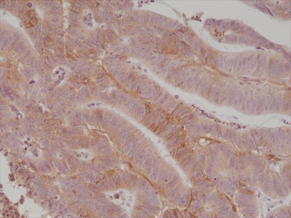  IHC resultImmunohistochemical staining of formalin fixed and paraffin embedded human colon cancer tissue section using anti-CD276 (B7-H3) rabbit monoclonal antibody (Clone RM335) at a 1:1000 dilution