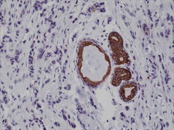  IHC resultImmunohistochemical staining of formalin fixed and paraffin embedded human breast cancer tissue sections using Anti-CK7 Rabbit Monoclonal Antibody (Clone RM284) at a 1:1000 dilution