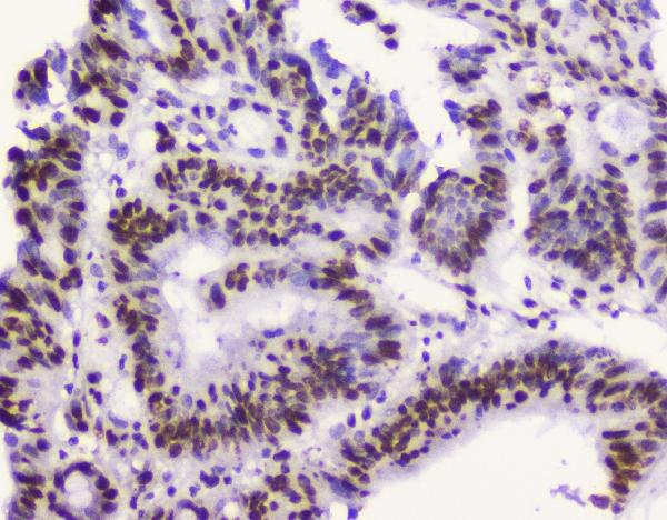 IHC analysis of RbAp48 using anti-RbAp48 antibody (M02702-1). RbAp48 was detected in paraffin-embedded section of human intestinal cancer tissue. Heat mediated antigen retrieval was performed in citrate buffer (pH6, epitope retrieval solution) for 20 mins. The tissue section was blocked with 10% goat serum. The tissue section was then incubated with 2μg/ml mouse anti-RbAp48 Antibody (M02702-1) overnight at 4°C. Biotinylated goat anti-mouse IgG was used as secondary antibody and incubated for 30 minutes at 37°C. The tissue section was developed using Strepavidin-Biotin-Complex (SABC)(Catalog # SA1021) with DAB as the chromogen.