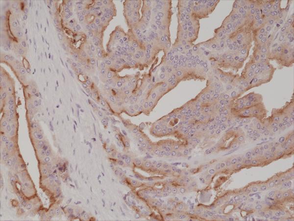  IHC resultImmunohistochemical staining of formalin fixed and paraffin embedded human prostate cancer tissue section using anti-PSMA rabbit monoclonal antibody (Clone RM327) at a 1:1000 dilution