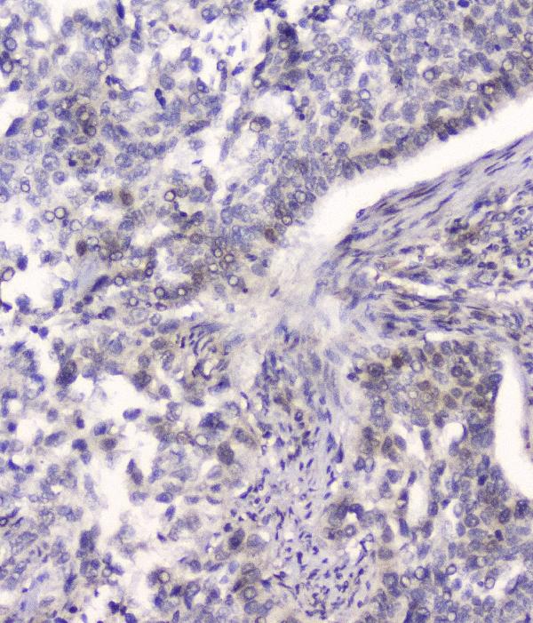IHC analysis of HSPA2 using anti-HSPA2 antibody (M03474-1). HSPA2 was detected in paraffin-embedded section of human lung cancer tissue. Heat mediated antigen retrieval was performed in citrate buffer (pH6, epitope retrieval solution) for 20 mins. The tissue section was blocked with 10% goat serum. The tissue section was then incubated with 2μg/ml mouse anti-HSPA2 Antibody (M03474-1) overnight at 4°C. Biotinylated goat anti-mouse IgG was used as secondary antibody and incubated for 30 minutes at 37°C. The tissue section was developed using Strepavidin-Biotin-Complex (SABC)(Catalog # SA1021) with DAB as the chromogen.