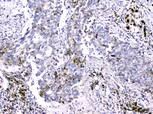 IHC analysis of Cytochrome C using anti-Cytochrome C antibody (M03529-5). Cytochrome C was detected in paraffin-embedded section of human lung cancer tissue. Heat mediated antigen retrieval was performed in citrate buffer (pH6, epitope retrieval solution) for 20 mins. The tissue section was blocked with 10% goat serum. The tissue section was then incubated with 2μg/ml mouse anti-Cytochrome C Antibody (M03529-5) overnight at 4°C. Biotinylated goat anti-mouse IgG was used as secondary antibody and incubated for 30 minutes at 37°C. The tissue section was developed using Strepavidin-Biotin-Complex (SABC)(Catalog # SA1021) with DAB as the chromogen.
