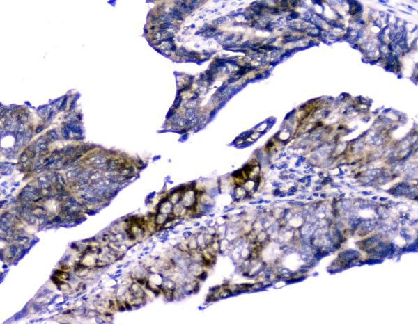 IHC analysis of Cytochrome C using anti-Cytochrome C antibody (M03529-5). Cytochrome C was detected in paraffin-embedded section of human intestinal cancer tissue. Heat mediated antigen retrieval was performed in citrate buffer (pH6, epitope retrieval solution) for 20 mins. The tissue section was blocked with 10% goat serum. The tissue section was then incubated with 2μg/ml mouse anti-Cytochrome C Antibody (M03529-5) overnight at 4°C. Biotinylated goat anti-mouse IgG was used as secondary antibody and incubated for 30 minutes at 37°C. The tissue section was developed using Strepavidin-Biotin-Complex (SABC)(Catalog # SA1021) with DAB as the chromogen.
