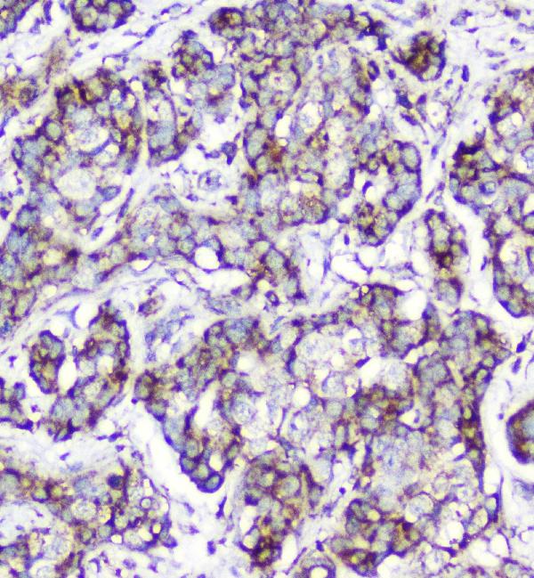 IHC analysis of Cytochrome C using anti-Cytochrome C antibody (M03529-5). Cytochrome C was detected in paraffin-embedded section of human mammary cancer tissue. Heat mediated antigen retrieval was performed in citrate buffer (pH6, epitope retrieval solution) for 20 mins. The tissue section was blocked with 10% goat serum. The tissue section was then incubated with 2μg/ml mouse anti-Cytochrome C Antibody (M03529-5) overnight at 4°C. Biotinylated goat anti-mouse IgG was used as secondary antibody and incubated for 30 minutes at 37°C. The tissue section was developed using Strepavidin-Biotin-Complex (SABC)(Catalog # SA1021) with DAB as the chromogen.