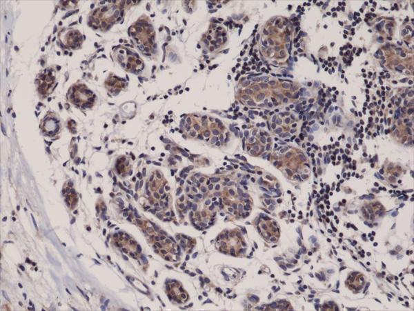  IHC resultImmunohistochemical staining of formalin fixed and paraffin embedded human breast cancer tissue sections using Anti-Smac/Diablo Rabbit Monoclonal Antibody (Clone RM271) at a 1:1000 dilution