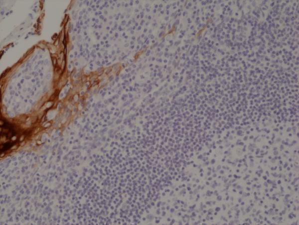  IHC resultImmunohistochemical staining of formalin fixed and paraffin embedded human tonsil tissue section using anti-CK-4 rabbit monoclonal antibody (Clone RM355) at a 1:1000 dilution