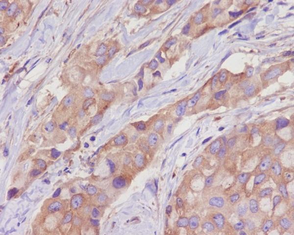 Immunohistochemical analysis of paraffin-embedded human breast cancer, using alpha Tubulin Antibody