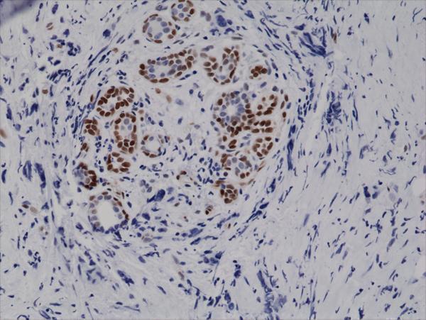  IHC resultImmunohistochemical staining of formalin fixed and paraffin embedded human breast cancer tissue sections using Anti-Phospho-Stat3 (Tyr705) Rabbit Monoclonal Antibody (clone RM261) at a 1:10,000 dilution