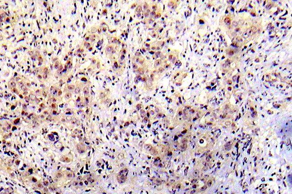 Immunohistochemistry (IHC) analyzes of p-P53 (S20) pAb in paraffin-embedded human breast carcinoma tissue.