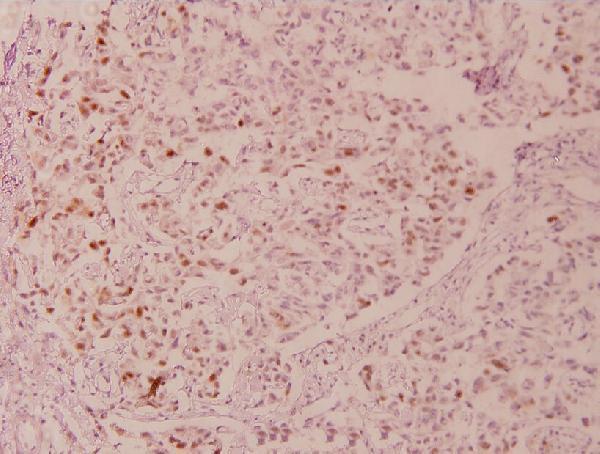 a00001s6 1 tp53 primary antiboties ihc testing 2