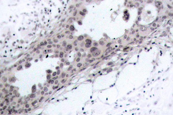 Immunohistochemistry (IHC) analyzes of PTEN (D375) pAb in paraffin-embedded human breast carcinoma tissue