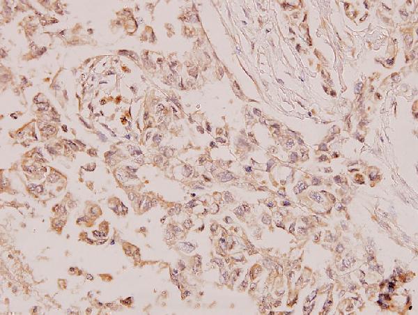 Immunohistochemistry (IHC) analyzes of PTEN (S364) pAb in paraffin-embedded human breast carcinoma tissue at 1:100