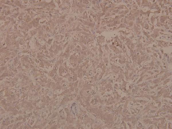 Immunohistochemistry (IHC) analyzes of p-PTEN (S370) pAb in paraffin-embedded human breast carcinoma tissue at 1:100