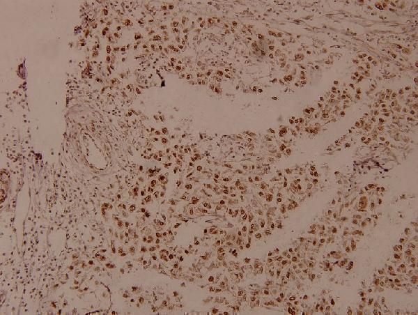 Immunohistochemistry (IHC) analyzes of p-PTEN (S380/T382/T383) pAb in paraffin-embedded human breast carcinoma tissue at 1:100
