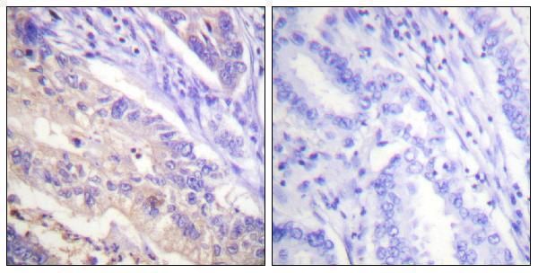 Immunohistochemistry analysis of paraffin-embedded human breast cancer, using PTEN (Phospho-Ser385) Antibody
