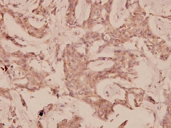 Immunohistochemistry (IHC) analyzes of PTEN (Y379) pAb in paraffin-embedded human breast carcinoma tissue at 1:100