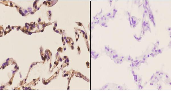 Immunohistochemistry (IHC) analyzes of Stat3 (S691) pAb in paraffin-embedded human lung carcinoma tissue at 1:50