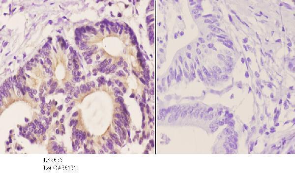 Immunohistochemistry (IHC) analyzes of Stat3 (S691) pAb in paraffin-embedded human colon carcinoma tissue at 1:50