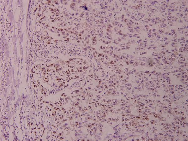 Immunohistochemistry (IHC) analyzes of p-Stat3 (S727) pAb in paraffin-embedded human breast carcinoma tissue at 1:100