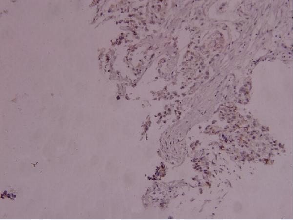 Immunohistochemistry (IHC) analyzes of p-STAT3 (Y705) pAb in paraffin-embedded human breast carcinoma tissue at 1:100