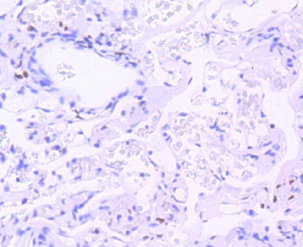 Immunohistochemical analysis of paraffin-embedded human lung tissue using anti-Phospho-STAT3(Tyr705) antibody