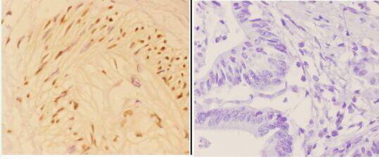 Immunohistochemistry (IHC) analyzes of APC (phospho-S2054) pAb in paraffin-embedded human colon carcinoma tissue at 1:50,showing cytoplasm and nuclear staining