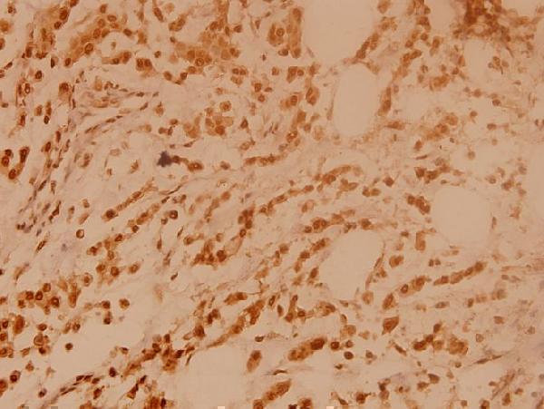 Immunohistochemistry (IHC) analyzes of BRCA2 (N60) pAb in paraffin-embedded human breast carcinoma tissue at 1:100