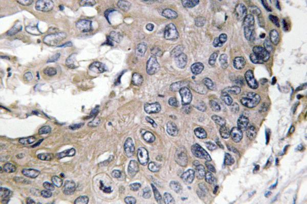 Immunohistochemistry analysis of ApoE antibody in paraffin-embedded human lung carcinoma tissue