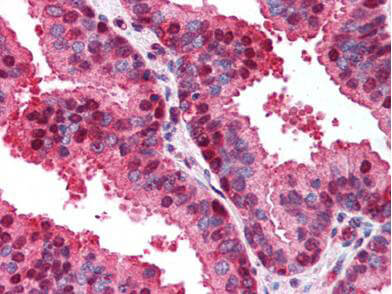 Boster's anti-p16 antibody was diluted 1:500 to detect p16 in human prostate tissue