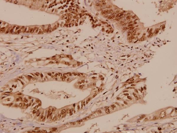 Immunohistochemistry (IHC) analyzes of Bcr (S356) pAb in paraffin-embedded human colorectal carcinoma tissue at 1:50