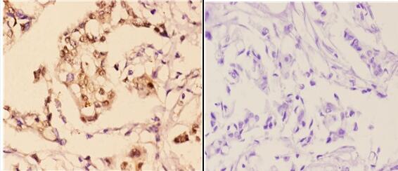 Immunohistochemistry (IHC) analyzes of p-AKT1 (S246) pAb in paraffin-embedded human breast carcinoma tissue at 1:50,showing cytoplasmic and nuclear and membrane staining