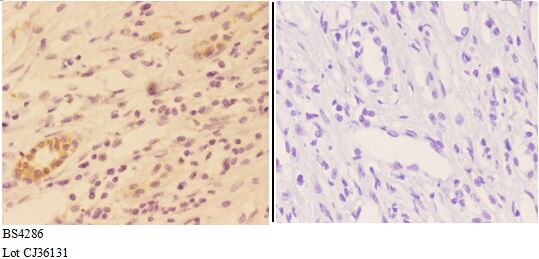 Immunohistochemistry (IHC) analyzes of AKT1 (phospho-S246) pAb in paraffin-embedded human kidney carcinoma tissue at 1:50,showing cytoplasm and nucleus staining