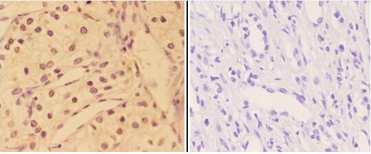 Immunohistochemistry (IHC) analyzes of AKT (phospho-Y315) pAb in paraffin-embedded human kidney carcinoma tissue at 1:50,showing cytoplasm ,nucleus and membrane staining
