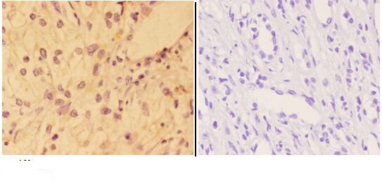 Immunohistochemistry (IHC) analyzes of AKT (phospho-Y326) pAb in paraffin-embedded human kidney carcinoma tissue at 1:50,showing cytoplasm and nucleus staining