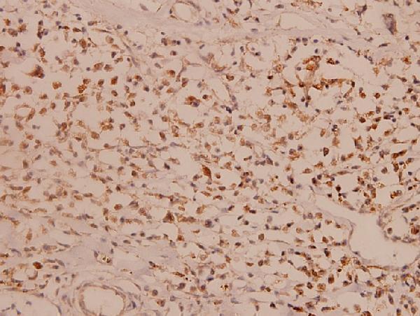 Immunohistochemistry (IHC) analyzes of Myc (R367) pAb in paraffin-embedded human breast carcinoma tissue at 1:100